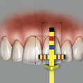 Hu-Friedy T-Bar Replacement Tips (3 Tips) -  TBARREF
