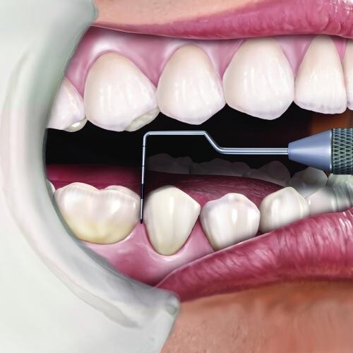 HU-FRIEDY PCPNT156.   15 UNC Novatech Color-Coded Probe.