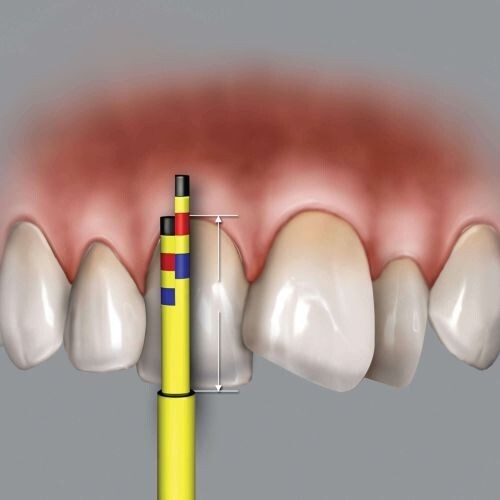 HU-FRIEDY Inline Replacement Tips (3 Tips)for Chu's Aesthetic Gauges.