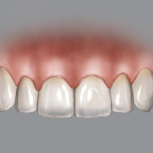 HU-FRIEDY  BLPGREF - CHU GAUGES BLPG REFILL TIPS 3PCS./PACK.